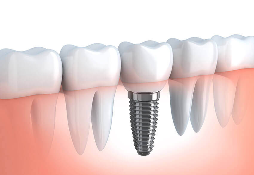 implantes-dentarios