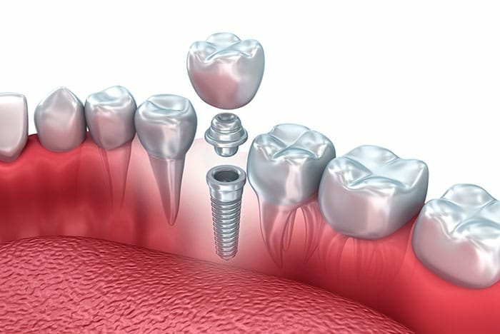 implante dentário